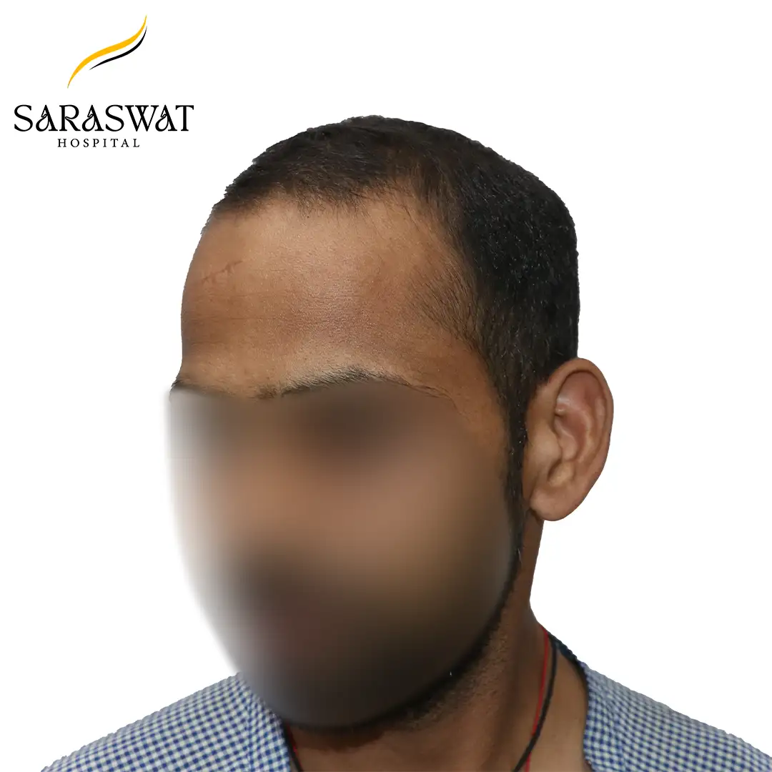 45 Degree Left FUE Hair Transplant Result Before Procedure