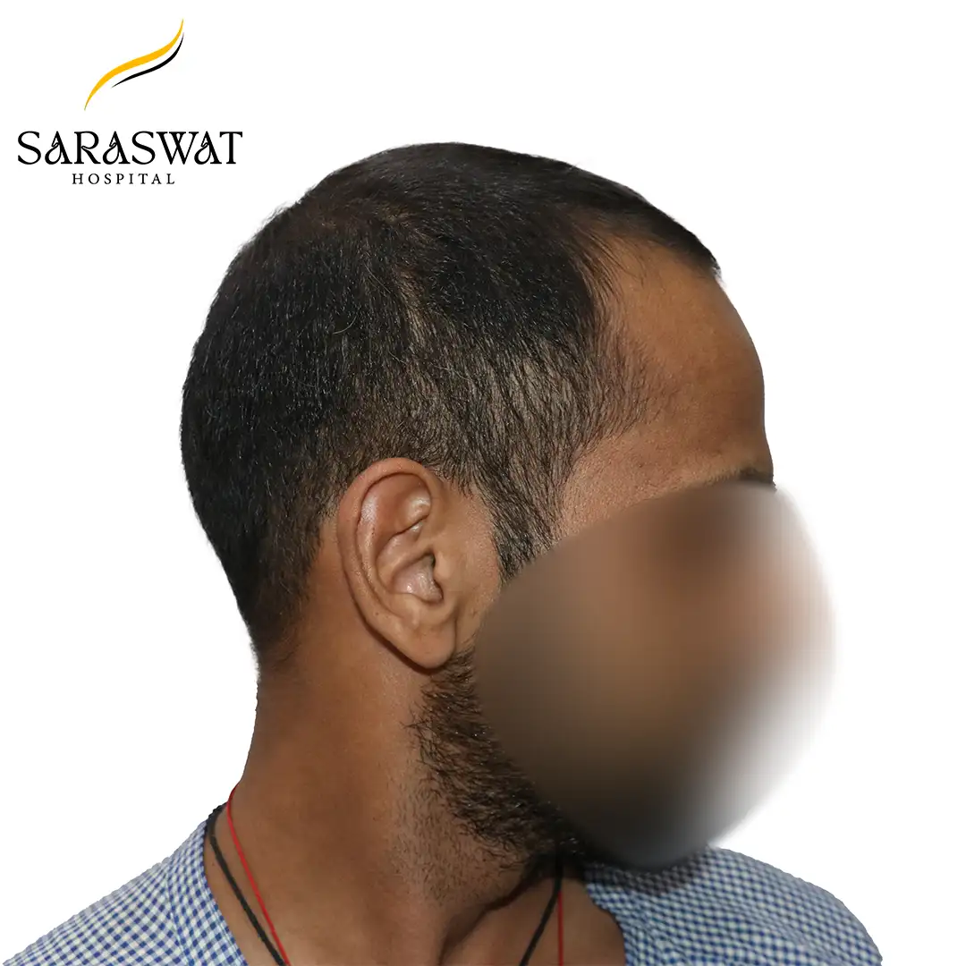 90 Degree Right FUE Hair Transplant Result Before Procedure