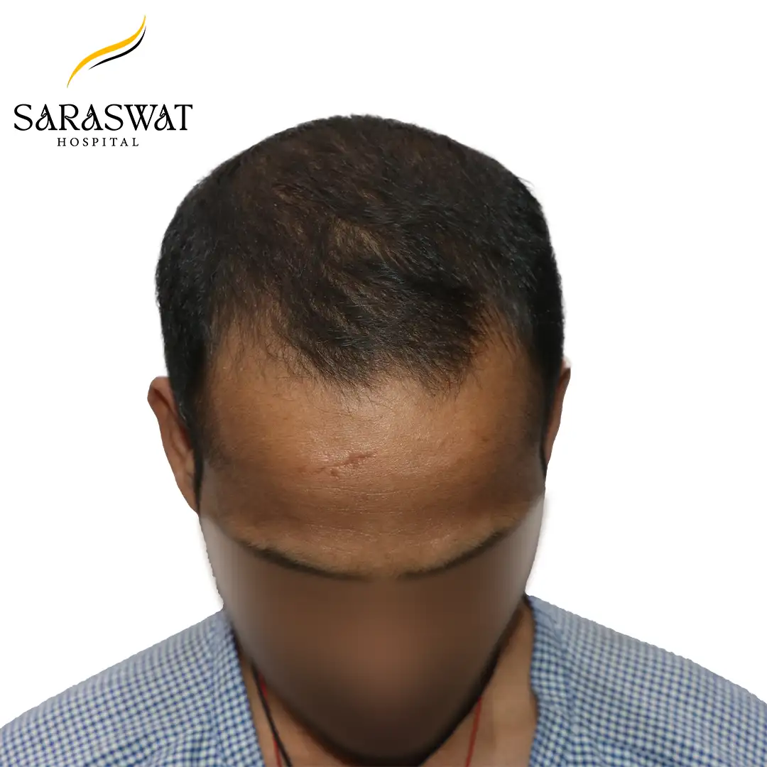 Top FUE Hair Transplant Result Before Procedure