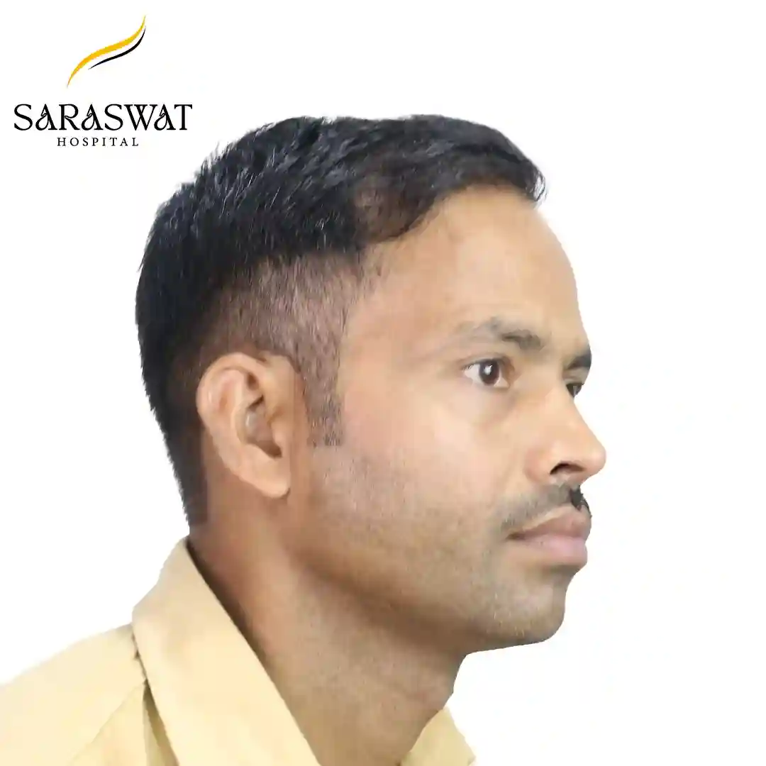 Hair Transplant Before After