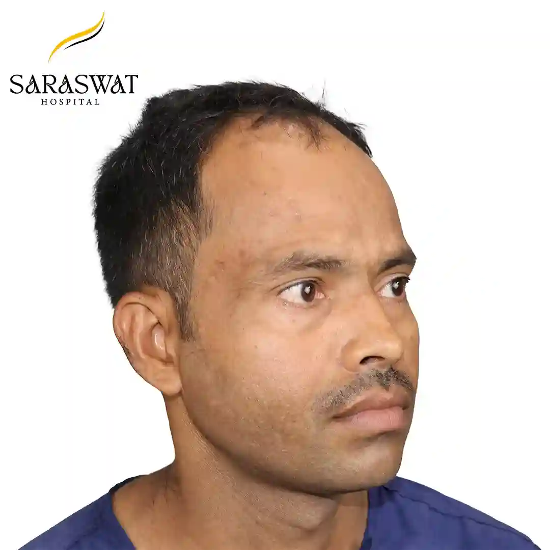 Hair Transplant Before After