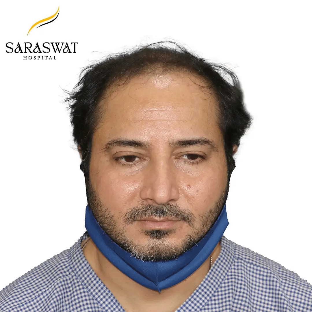 Hair Transplant Before and After Results