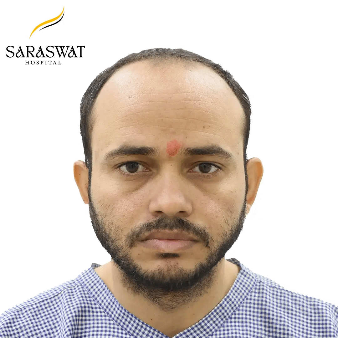 Hair Transplant Before and After