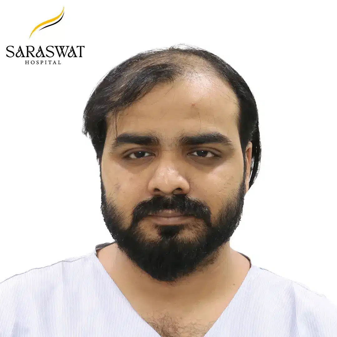 Hair Transplant Before and After