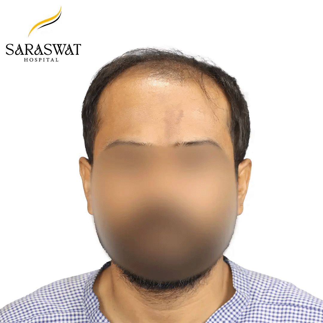 Hair Transplant Before and After
