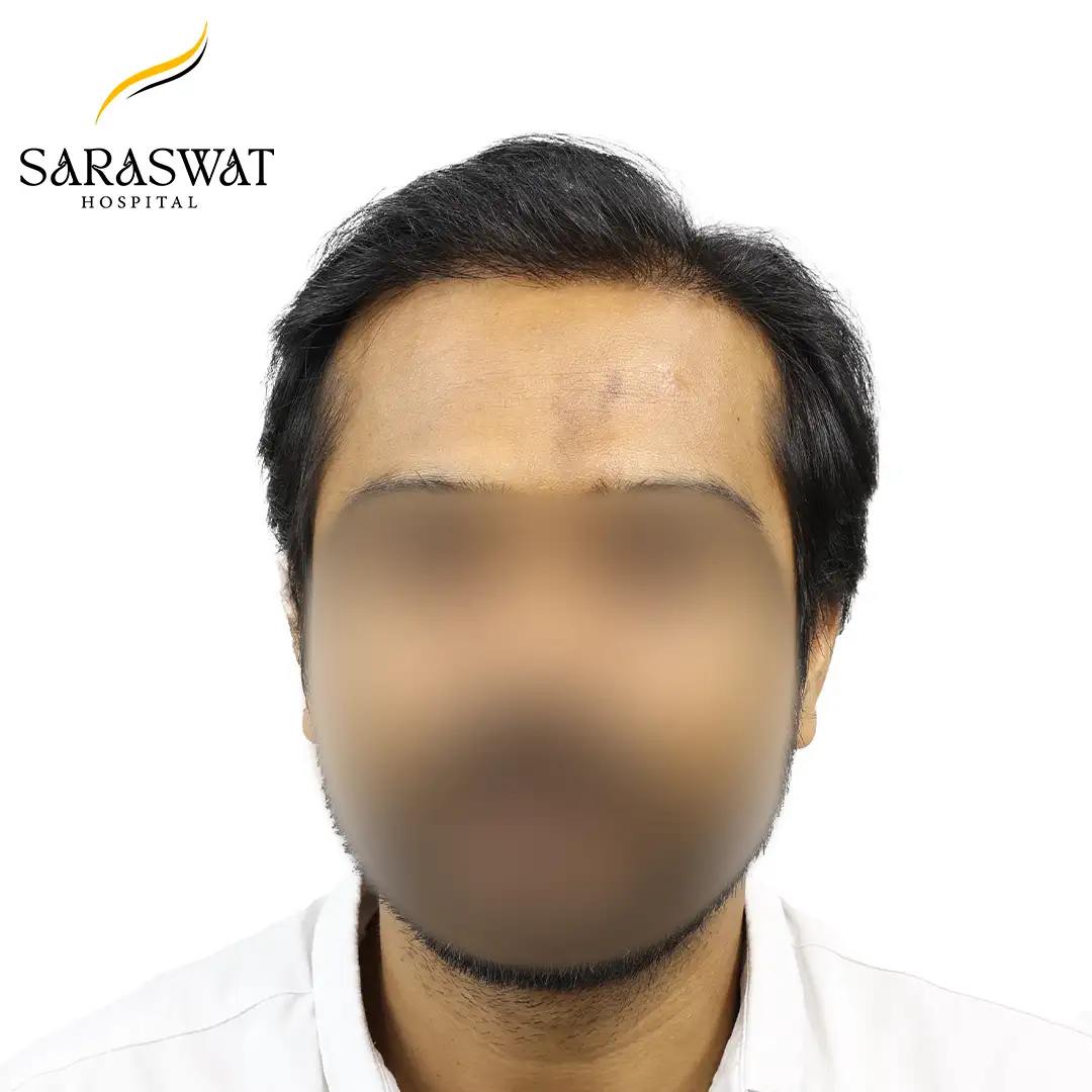 Front FUE Hair Transplant Result After Procedure