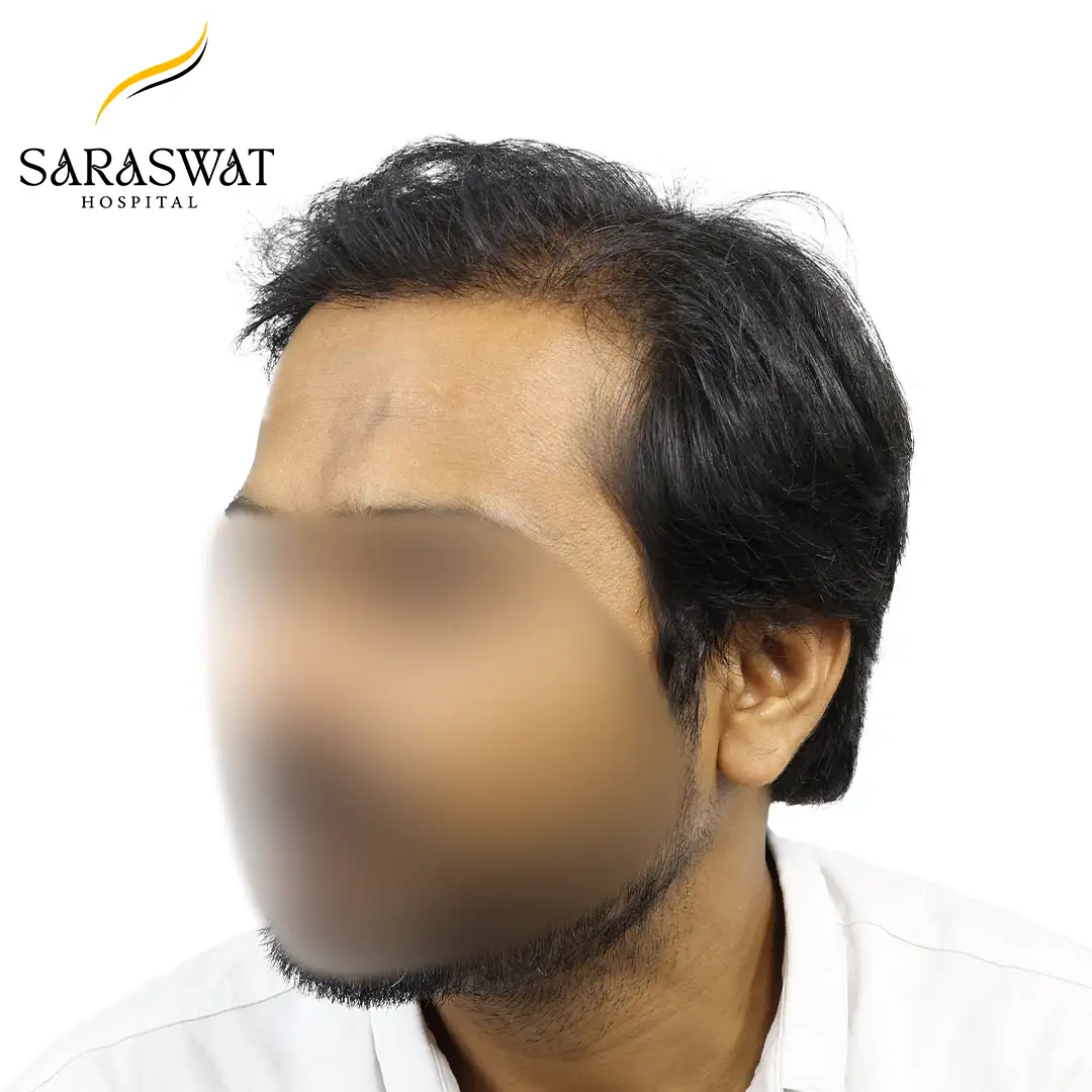Hair Transplant Before and After