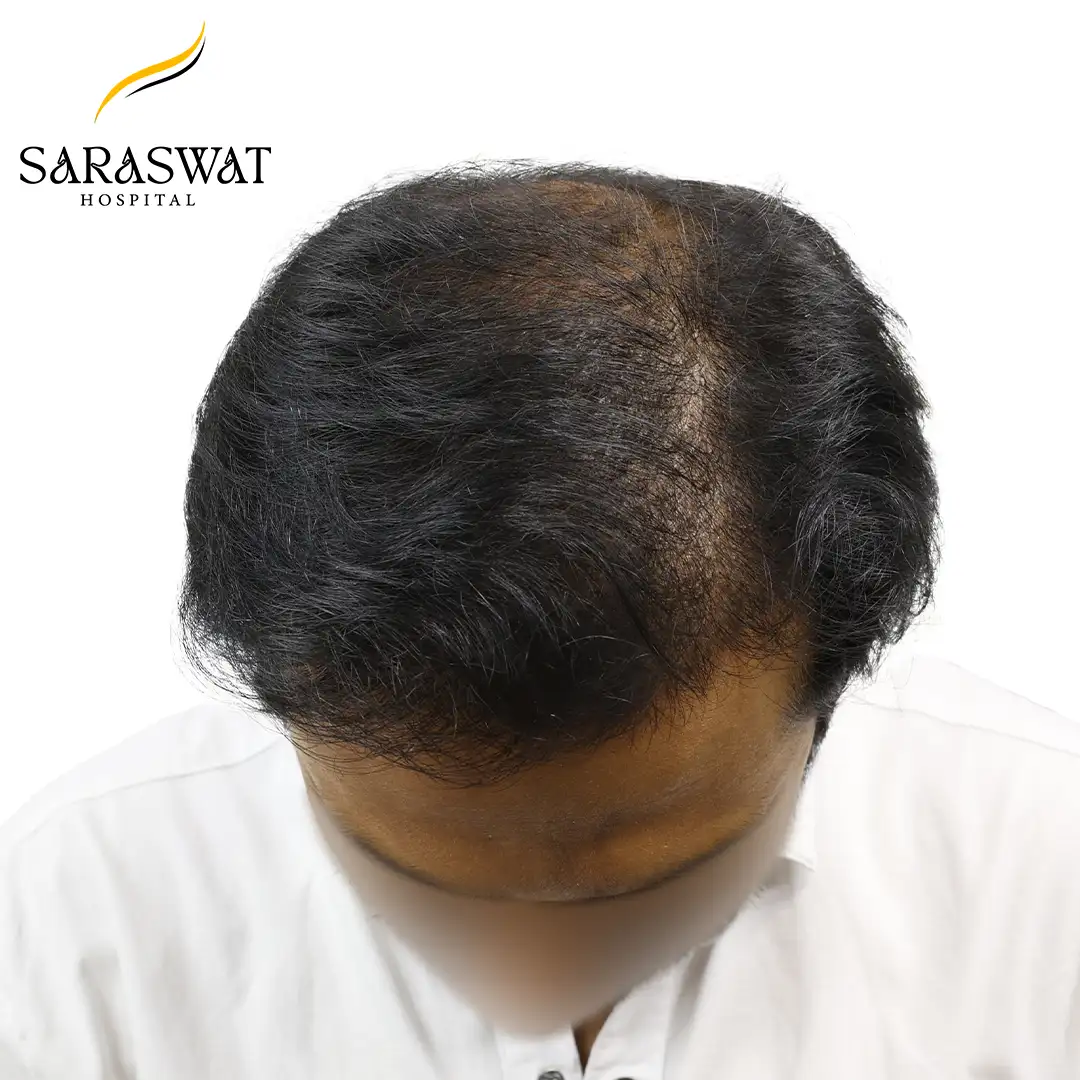 Top FUE Hair Transplant Result After Procedure