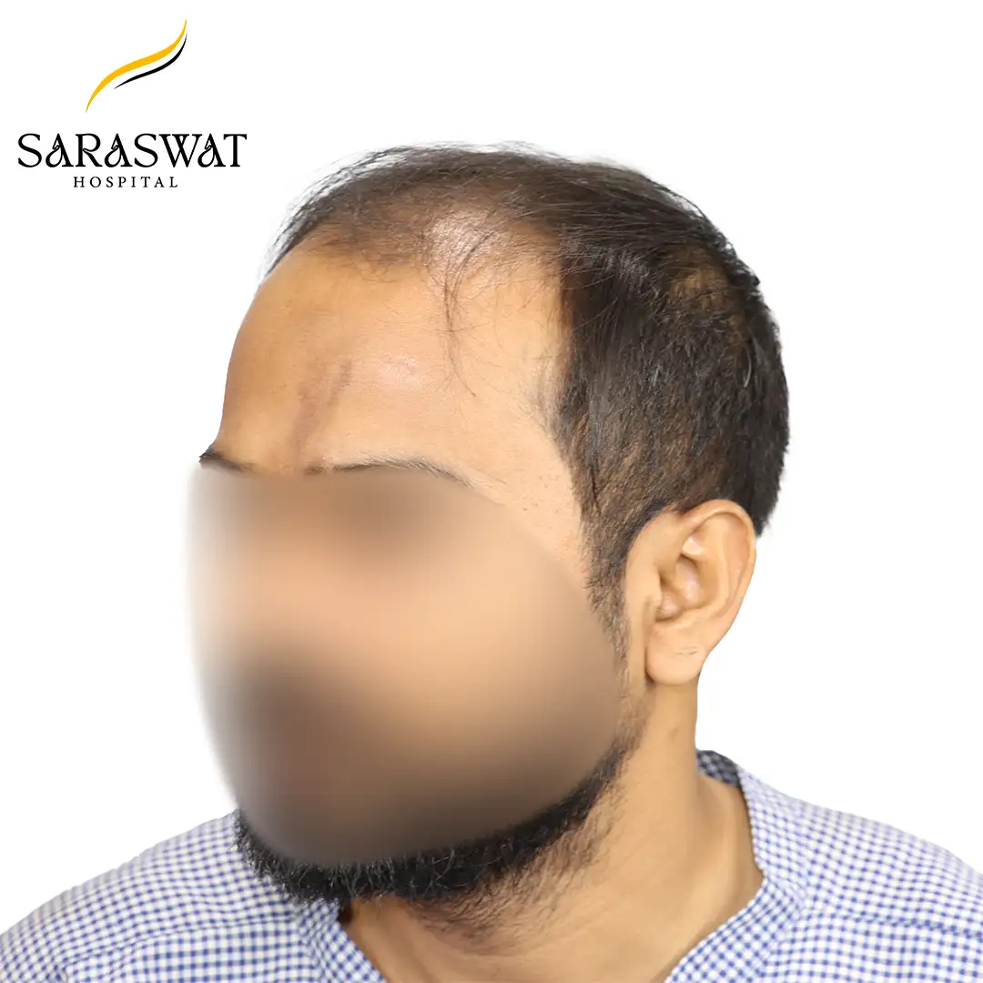 45 Degree Left FUE Hair Transplant Result Before Procedure