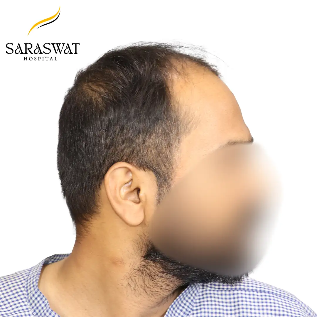 90 Degree Right FUE Hair Transplant Result Before Procedure