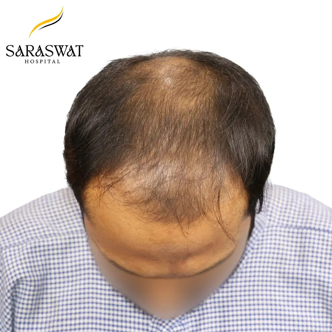 Top FUE Hair Transplant Result Before Procedure