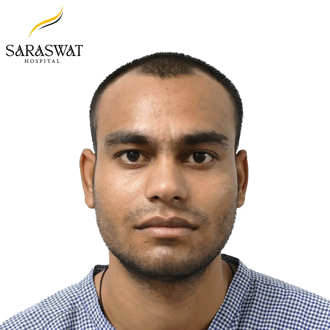 Hair Transplant Before and After