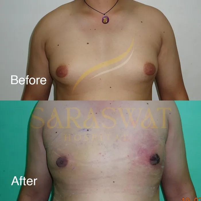 Gynecomastia Surgery Before and After