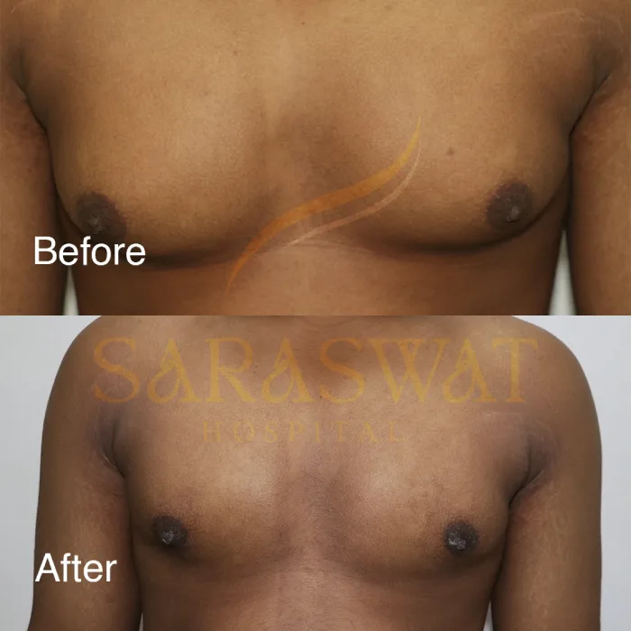Gynecomastia Surgery Before and After