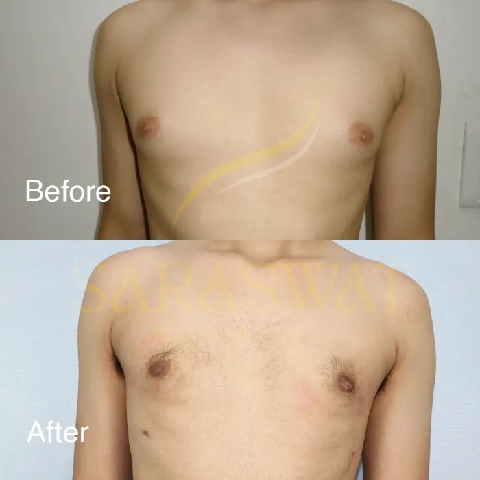 Gynecomastia Surgery Before and After