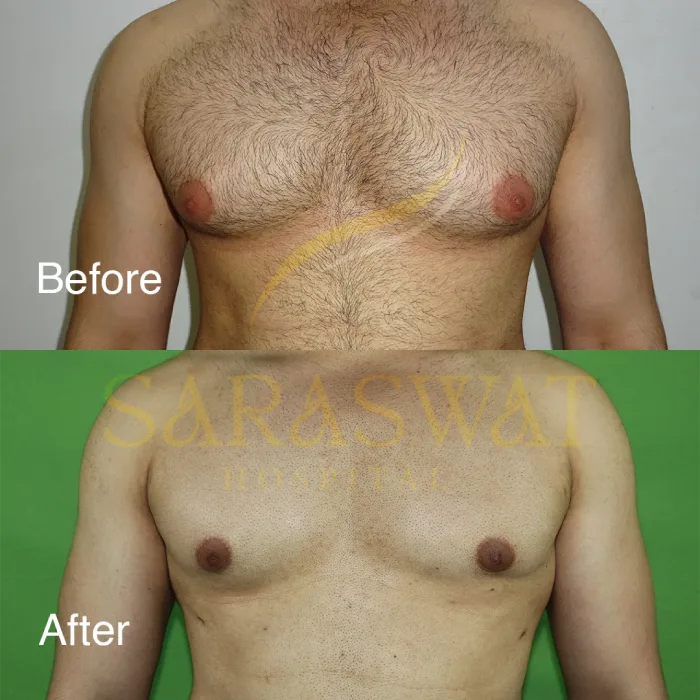 Gynecomastia Surgery Before and After