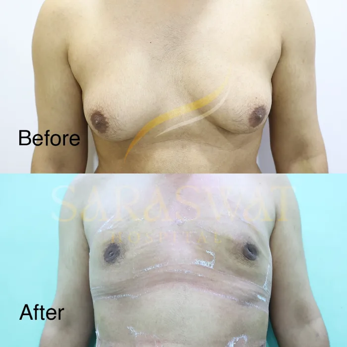 Gynecomastia Surgery Before and After