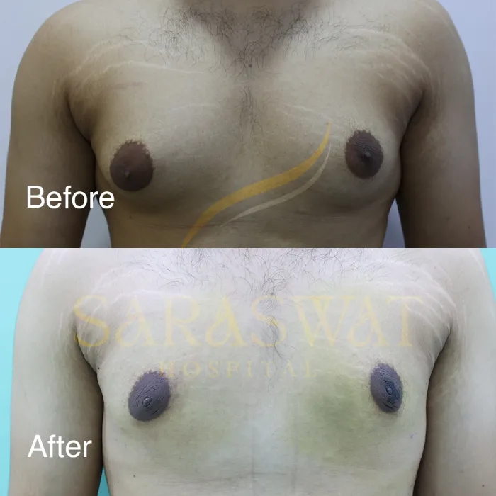 Gynecomastia Surgery Before and After