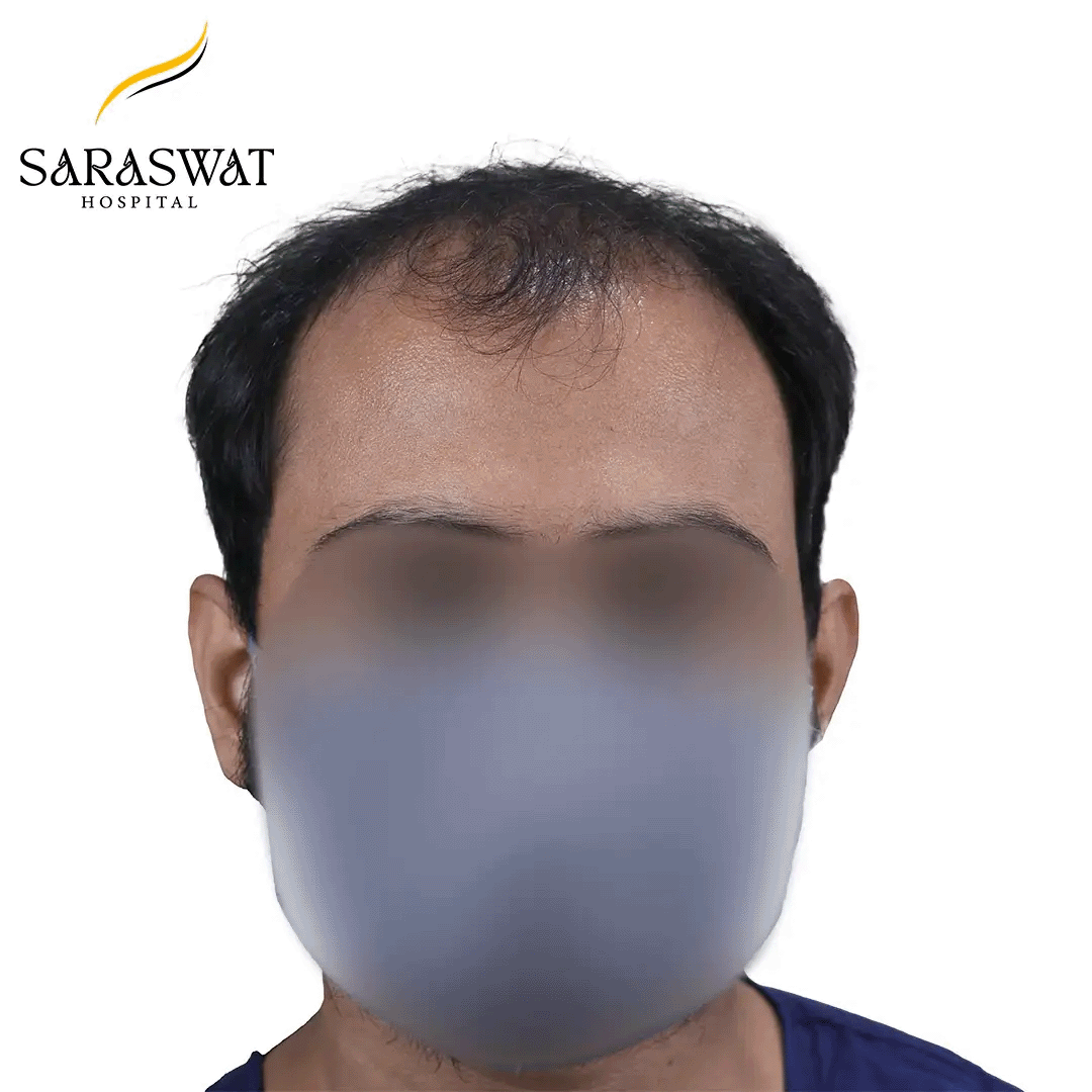 Hair Transplant Before and After Results