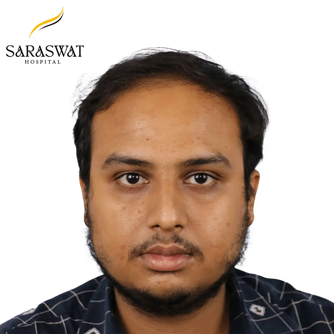 Hair Transplant Before and After