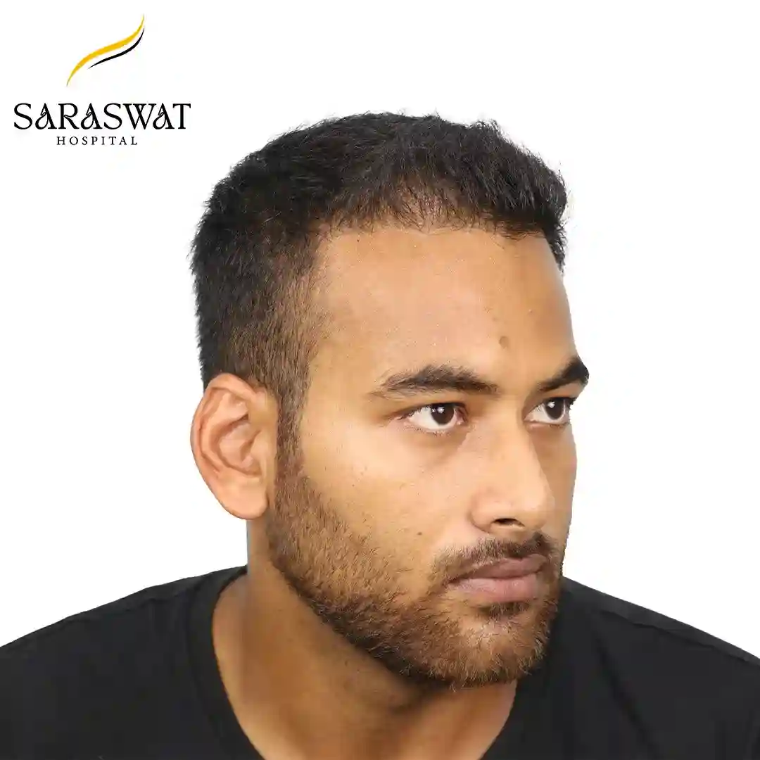 Hair Transplant Before After