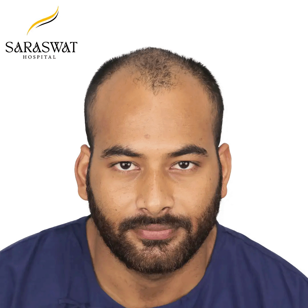 Hair Transplant Before After