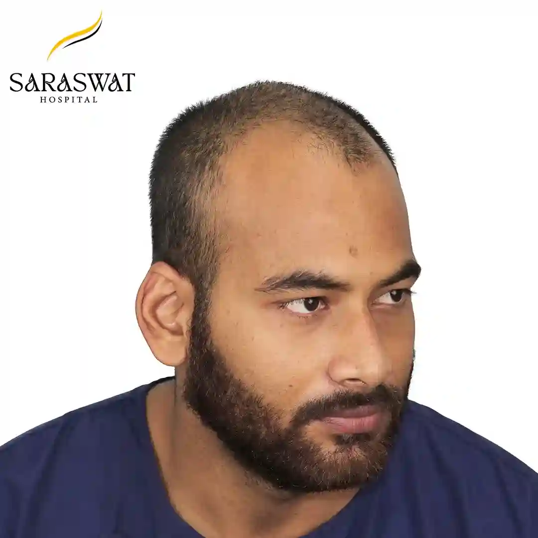 Hair Transplant Before After