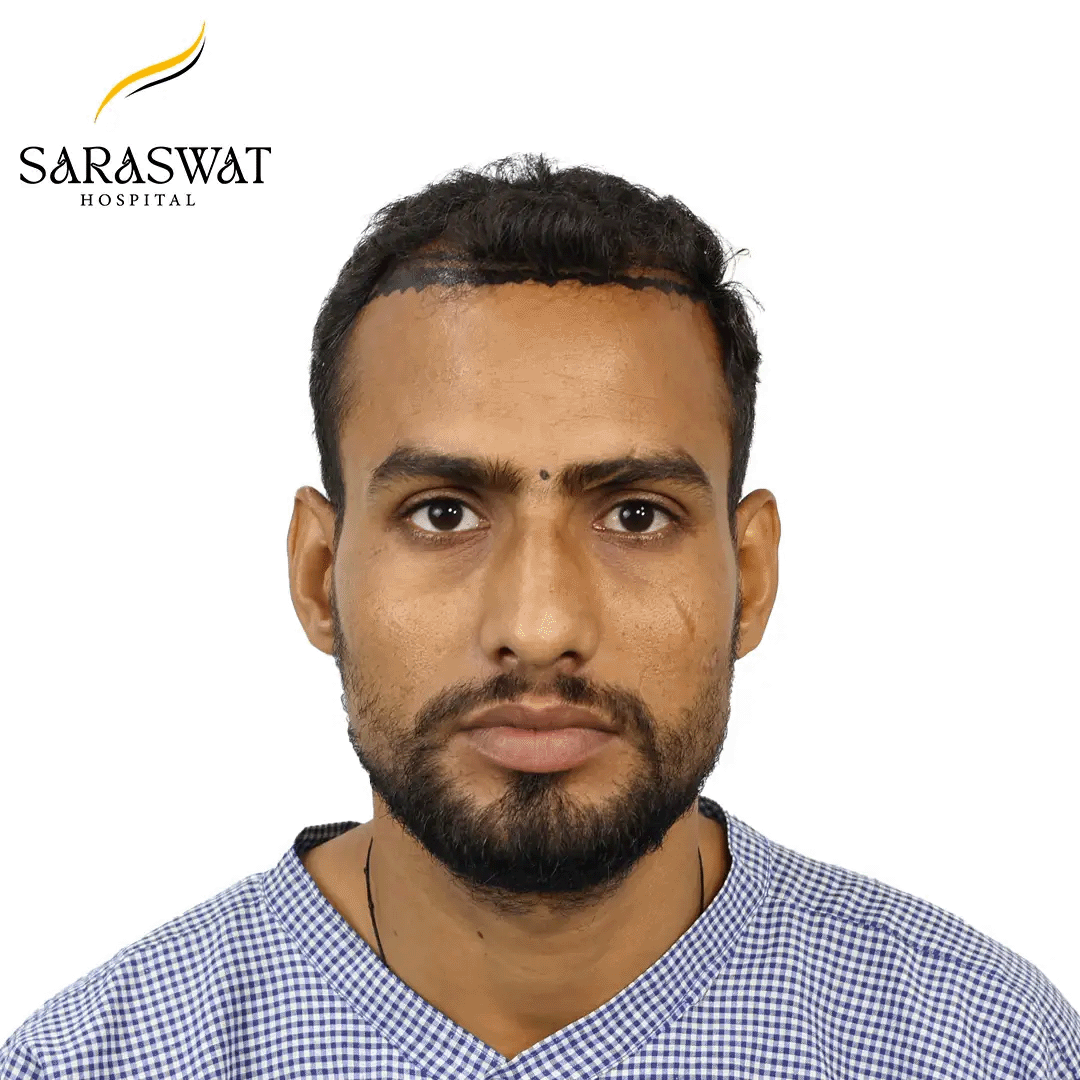 Hair Transplant Before After