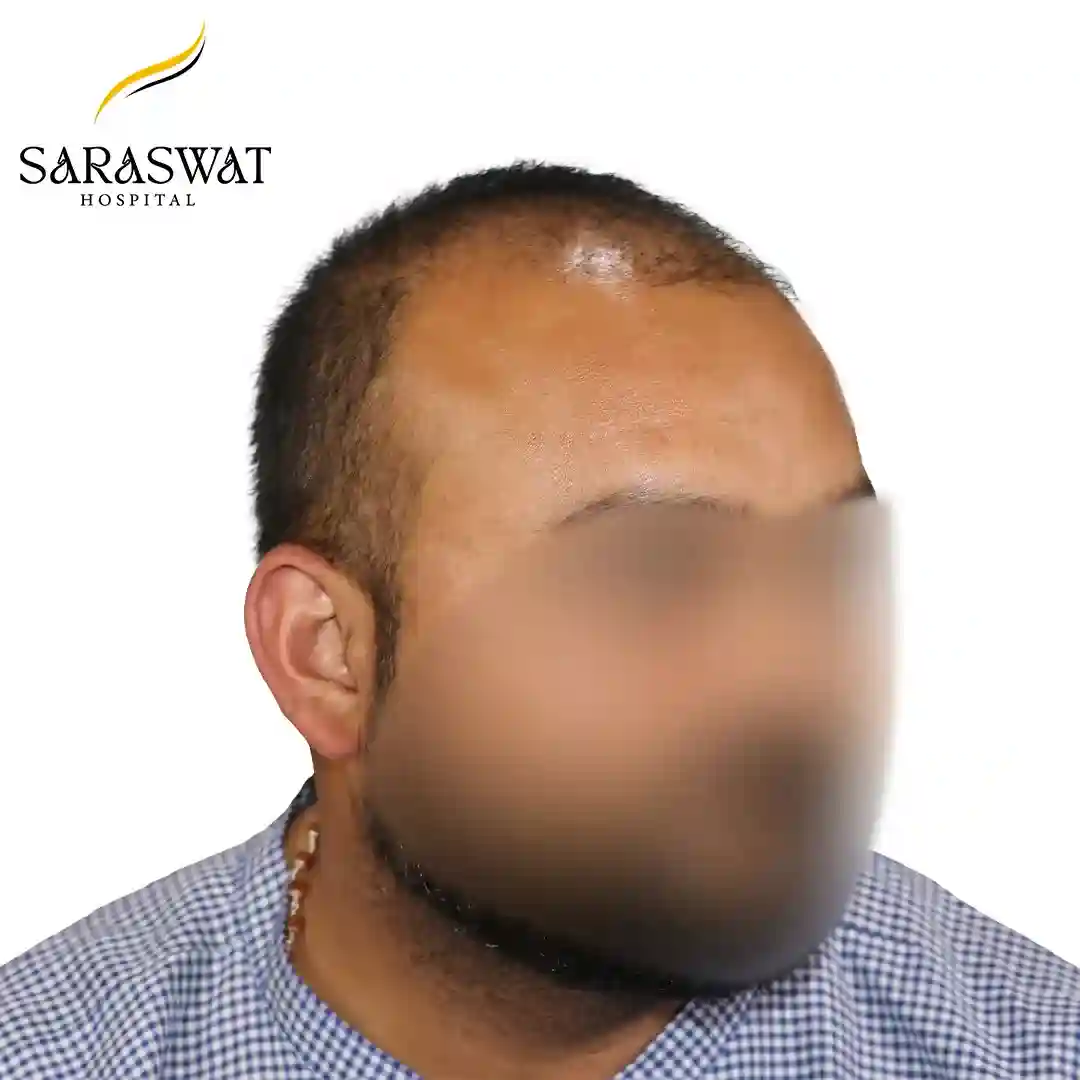 Hair Transplant Result