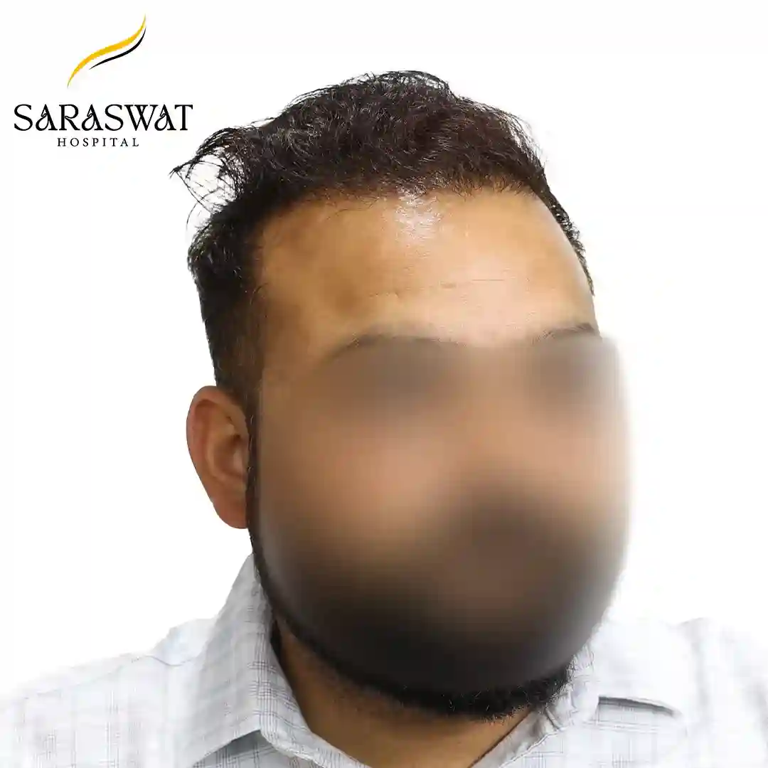 Hair Transplant Result