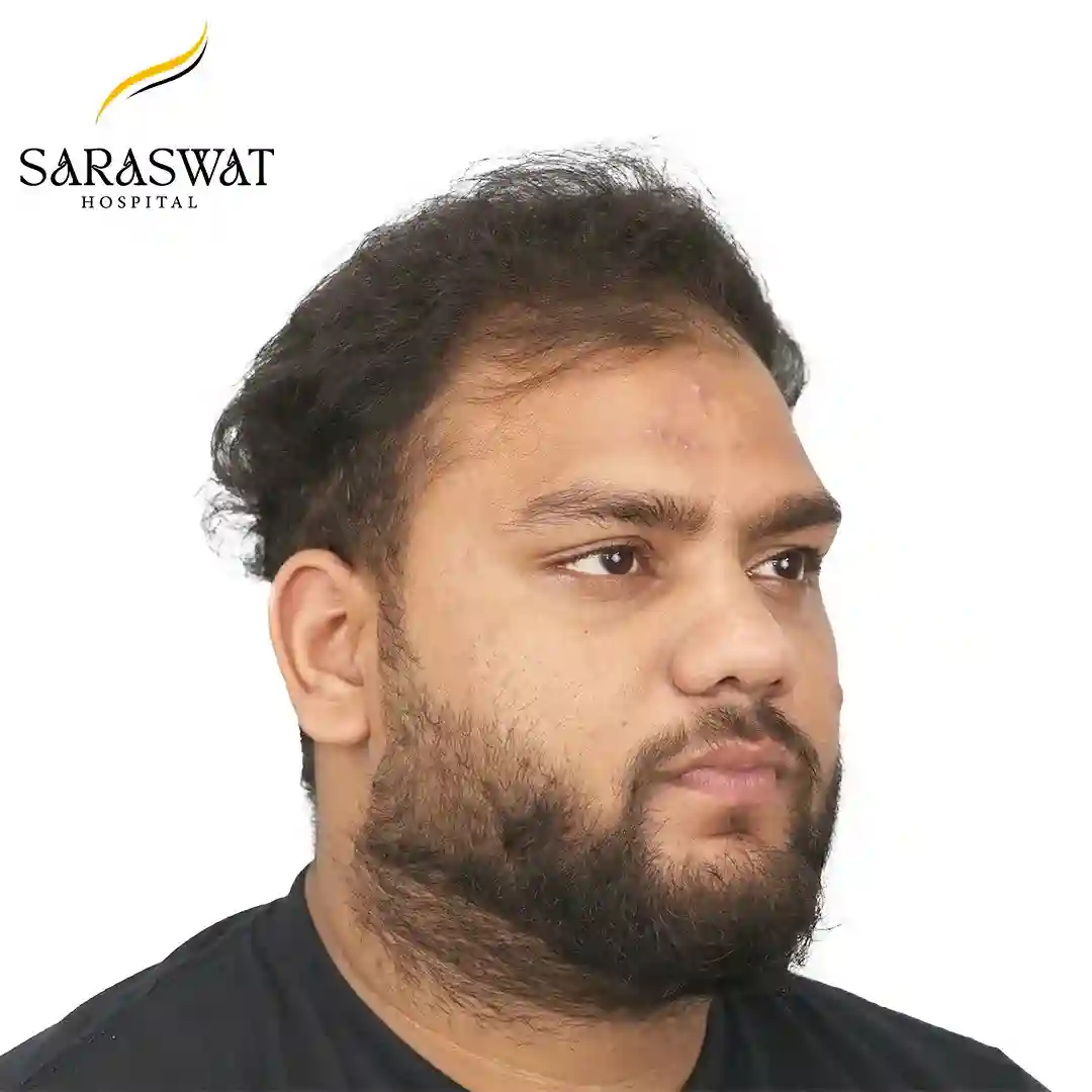 45 Degree Right FUE Hair Transplant Result After Procedure