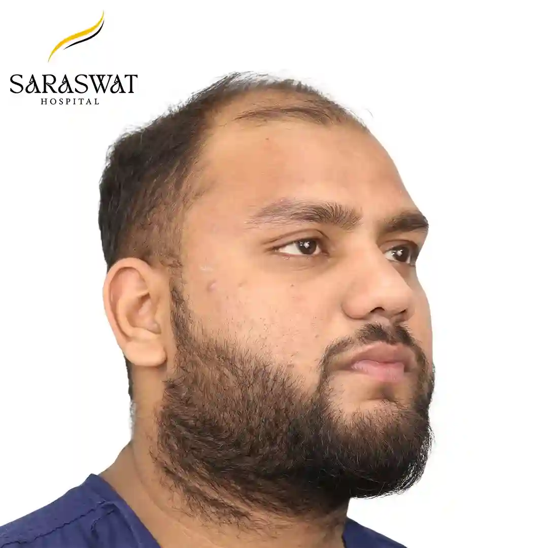 45 Degree Right FUE Hair Transplant Result Before Procedure