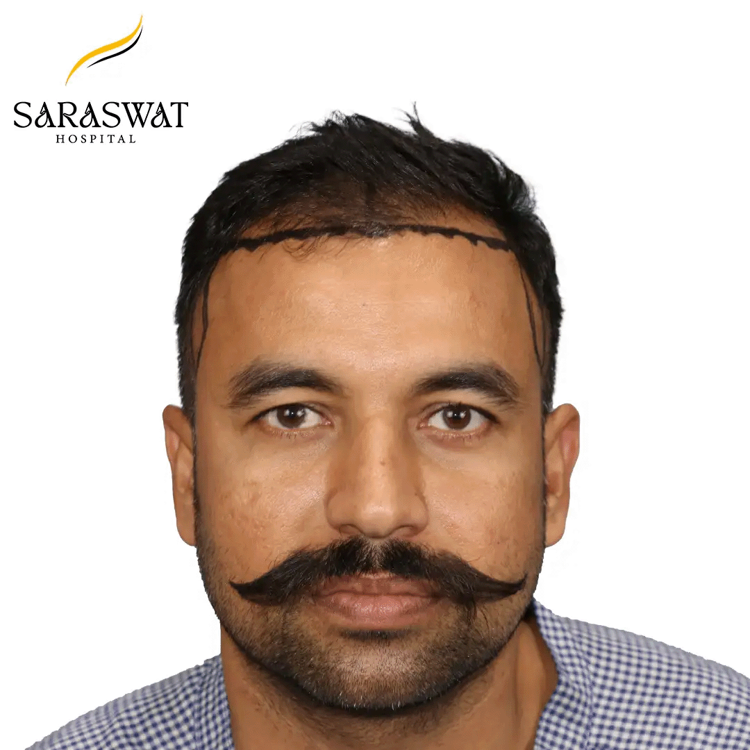 Hair Transplant Before After