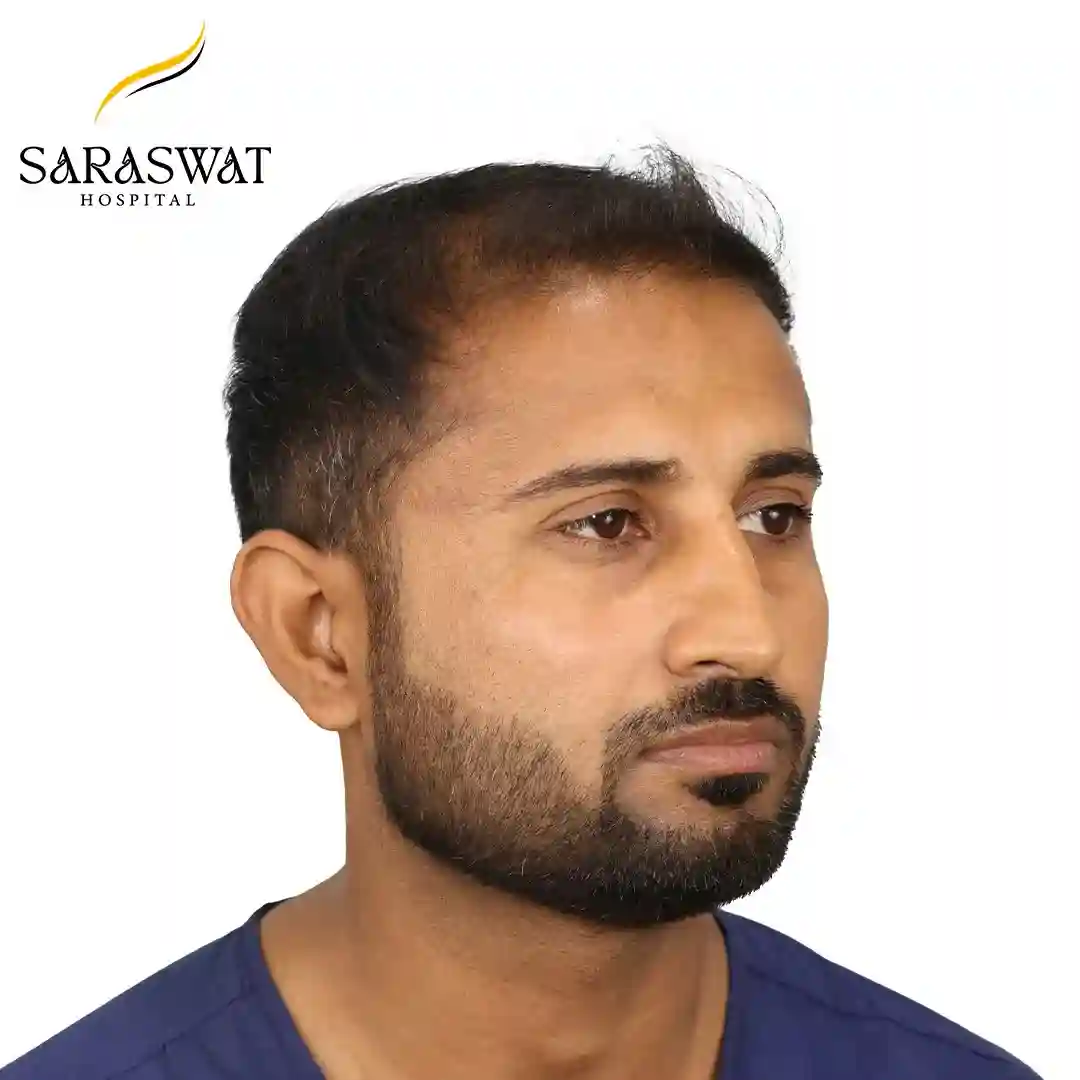 Best Hair Transplant Clinic in India | Saraswat Hospital