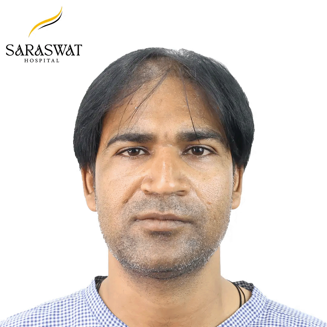 Hair Transplant Results