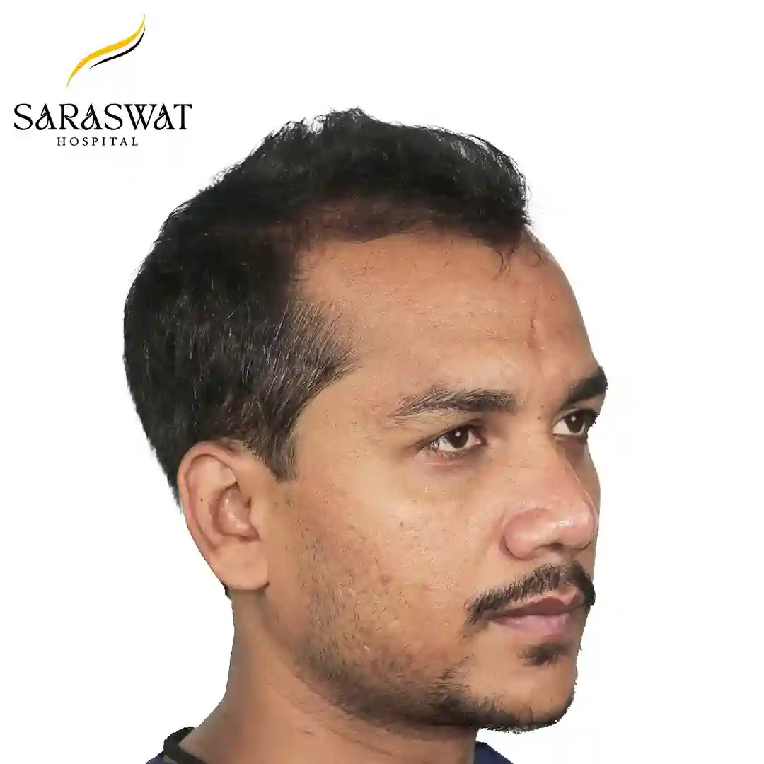 45 Degree Right FUE Hair Transplant Result Before Procedure