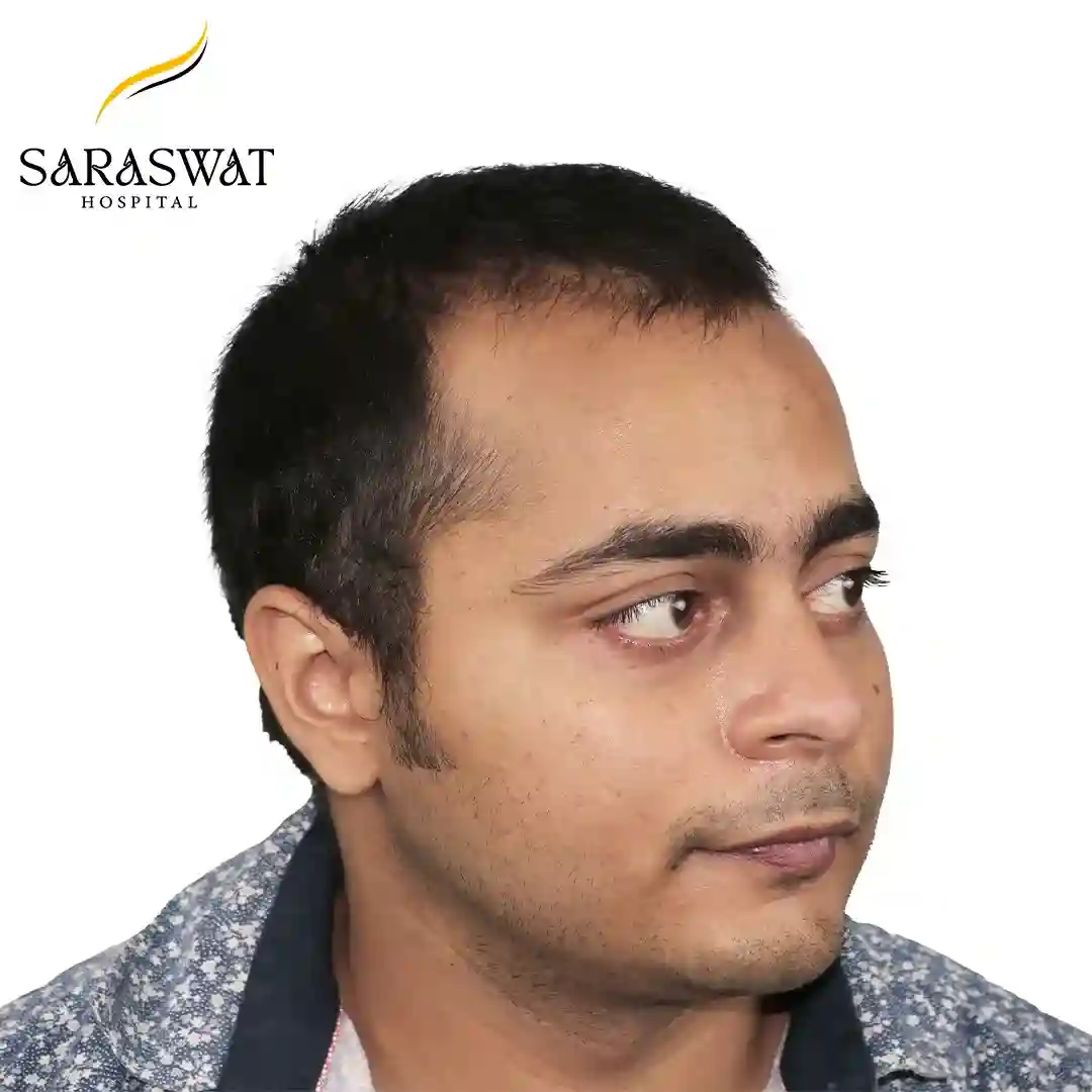 Hair Transplant Before After