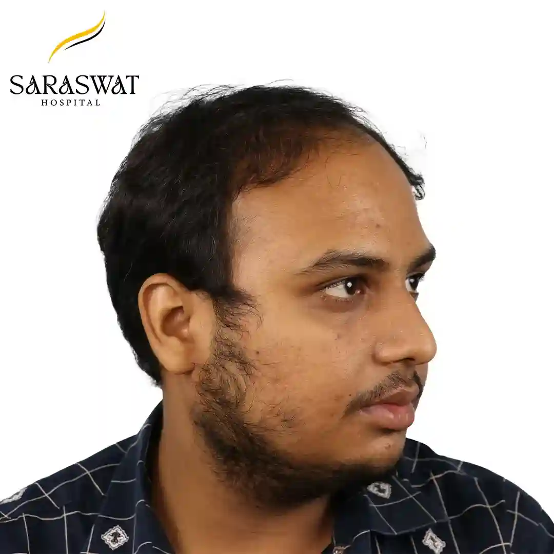 Hair Transplant Before After