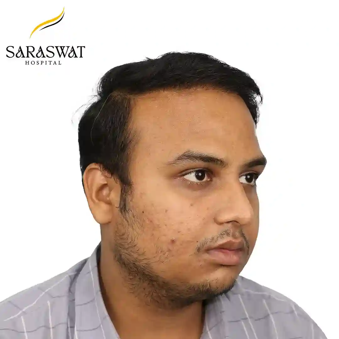 Hair Transplant Before After