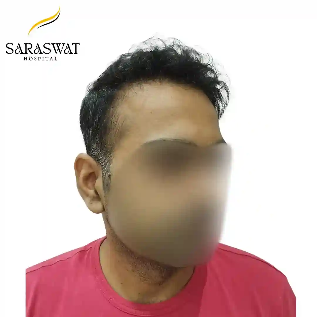 45 Degree Right FUE Hair Transplant Result After Procedure