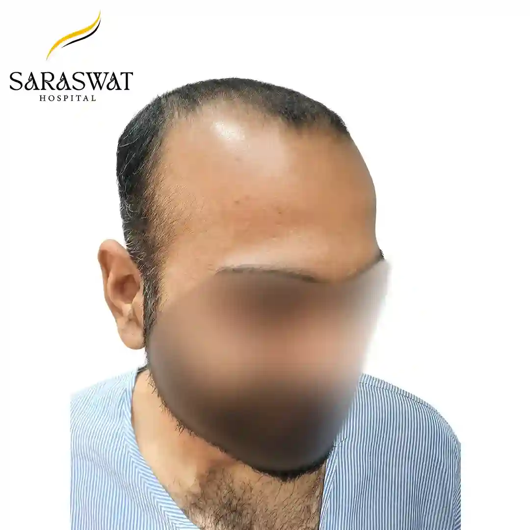 45 Degree Right FUE Hair Transplant Result Before Procedure