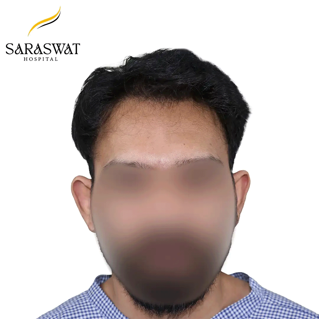 Hair Transplant Before and After