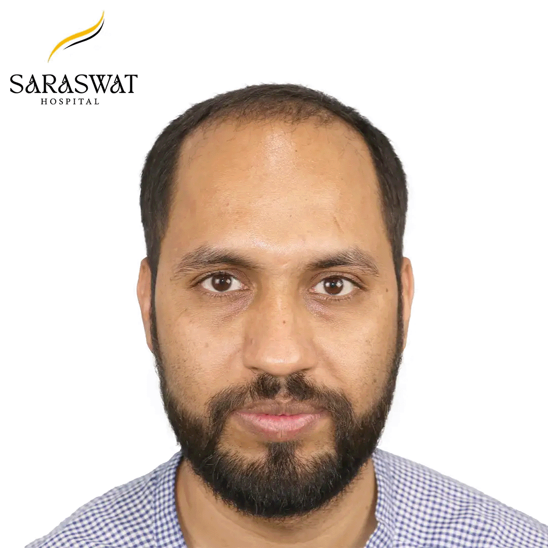 Hair Transplant Before and After Results