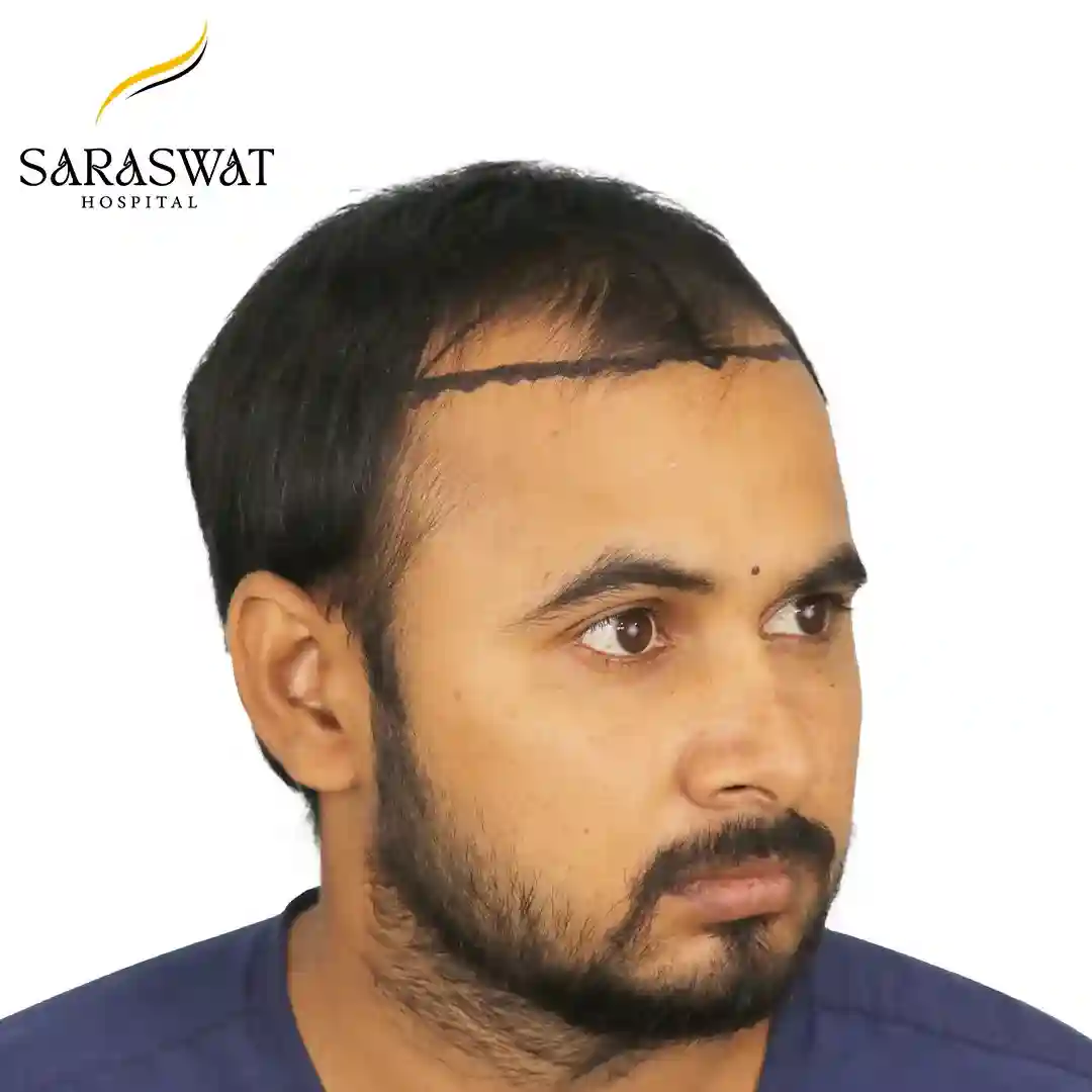 45 Degree Right FUE Hair Transplant Result Before Procedure