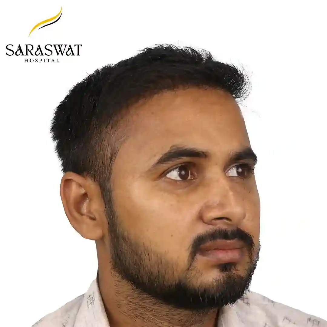 45 Degree Right FUE Hair Transplant Result After Procedure