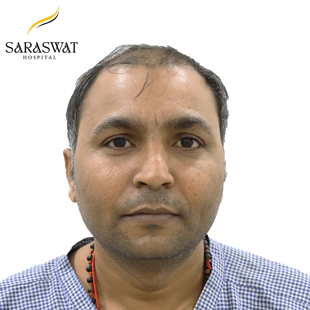 Hair Transplant Before and After Results