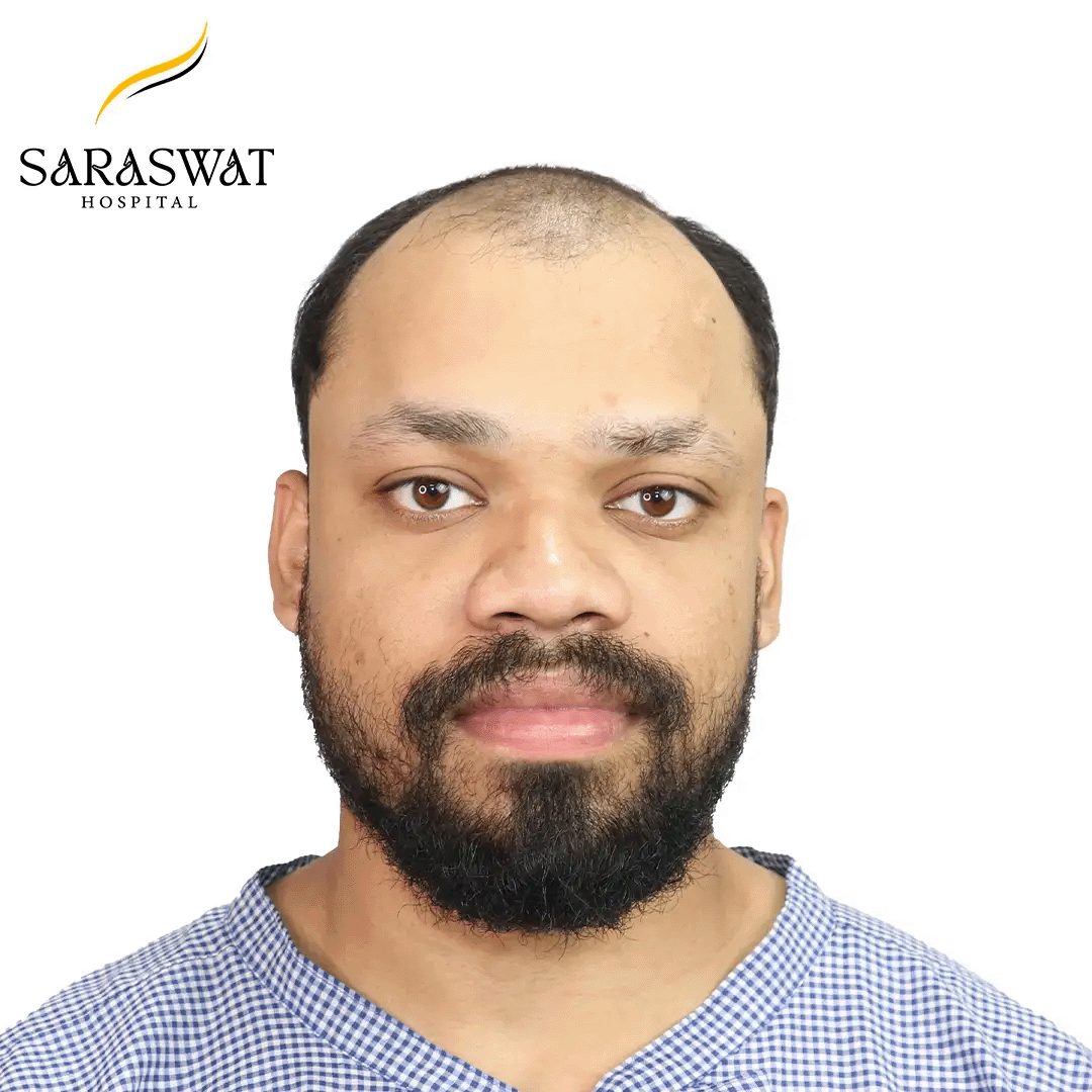 Hair Transplant Before and After Results