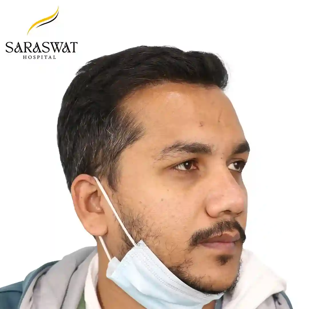 45 Degree Right FUE Hair Transplant Result After Procedure