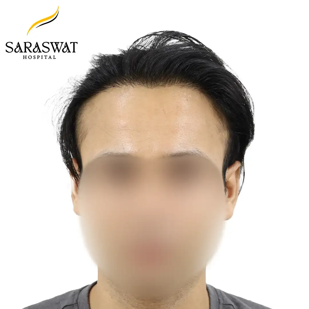 Front FUE Hair Transplant Result After Procedure