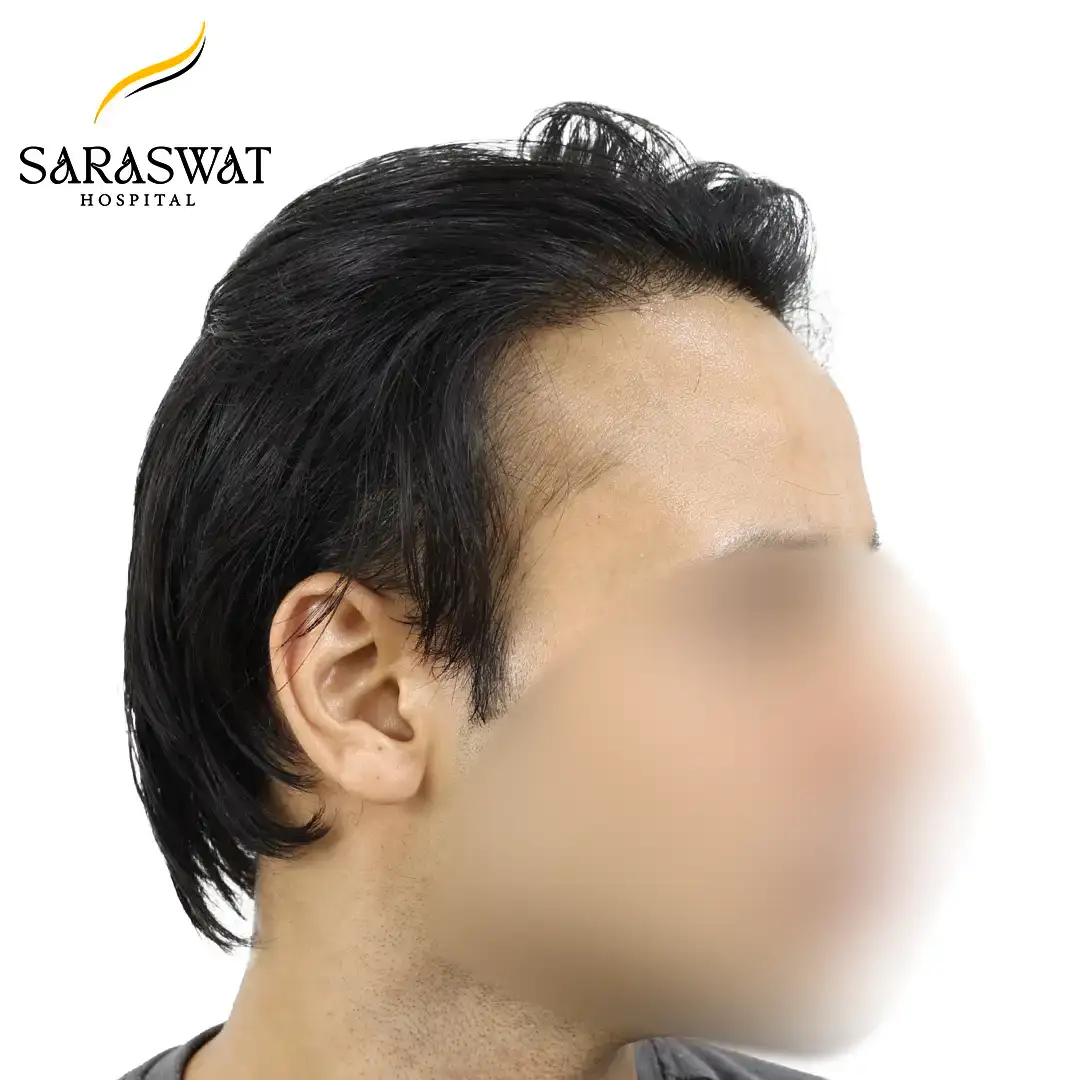 90 Degree Right FUE Hair Transplant Result After Procedure